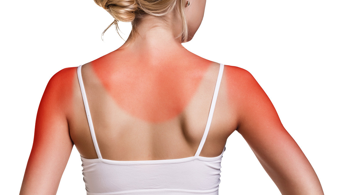 Chica con quemadura de sol en la espalda