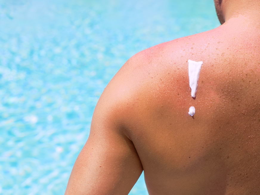 Espalda con protector solar para evitar el cáncer de piel