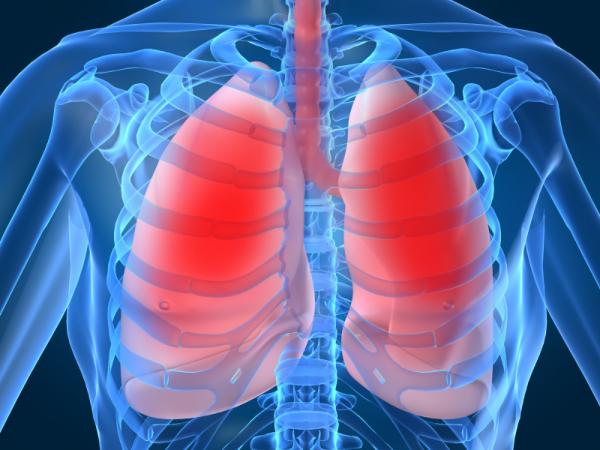 Síntomas de la pulmonía bilateral o neumonía doble