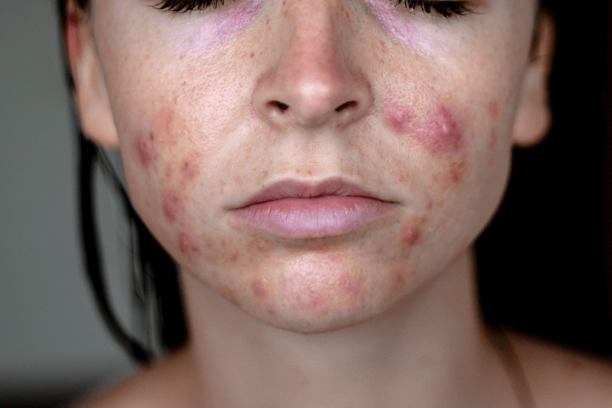 Mujer afectada con acné